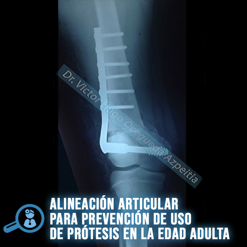 ALINEACIÓN ARTICULAR PARA LA PREVENCIÓN DE PRÓTESIS EN LA EDAD ADULTA