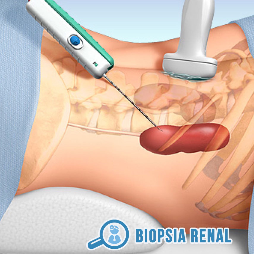 Biopsia Renal