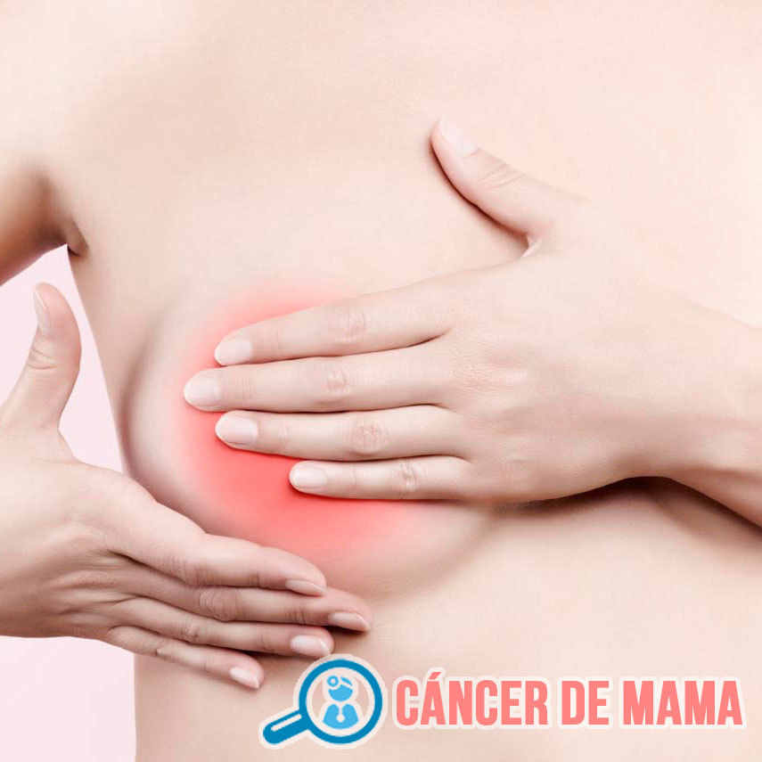 CÁNCER DE MAMA