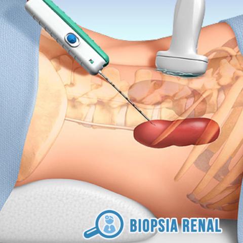 Biopsia Renal