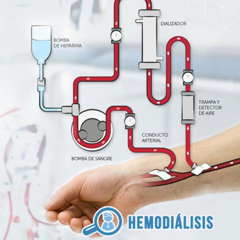 Hemodiálisis