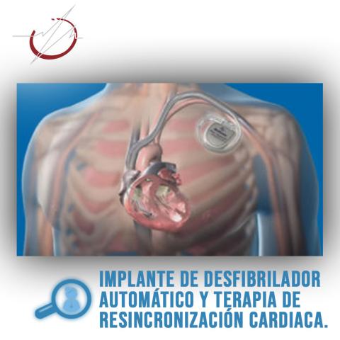 IMPLANTE DE DESFIBRILADOR AUTOMÁTICO Y TERAPIA DE RESINCRONIZACIÓN CARDIACA