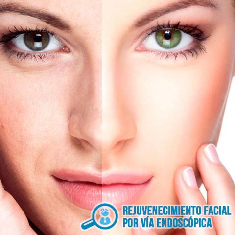 REJUVENECIMIENTO FACIAL POR VIA ENDOSCOPICA