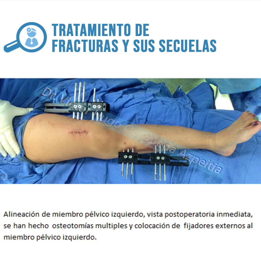 TRATAMIENTO DE FRACTURAS Y SUS SECUELAS