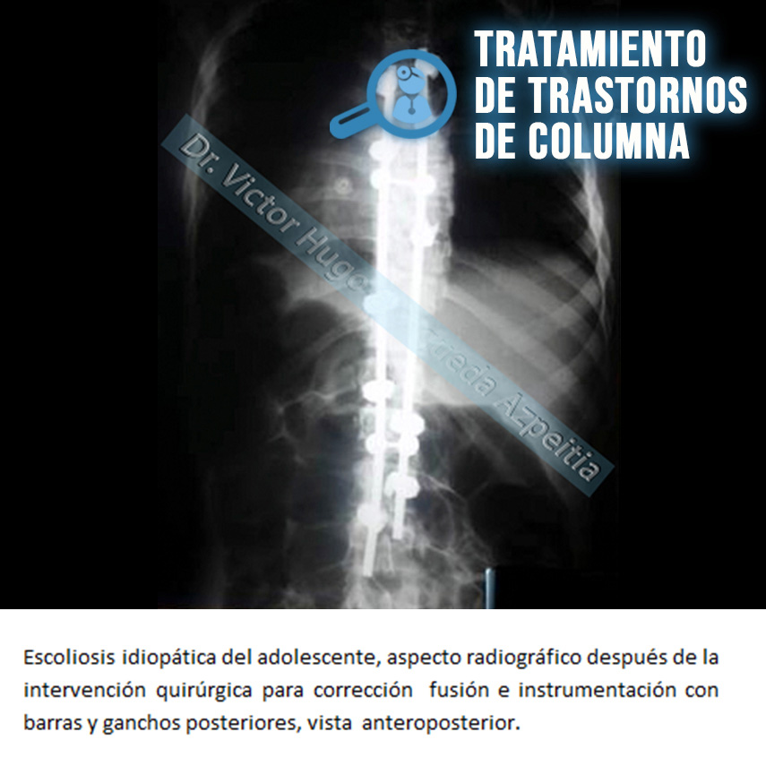 TRASTORNOS DE COLUMNA